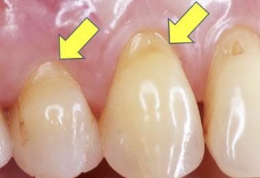 くさび欠損(WSD)