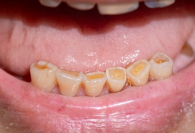 表面がけずれすぎた状態の歯