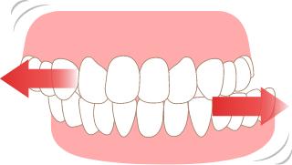歯ぎしりタイプイラスト