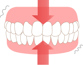 食いしばりタイプイラスト