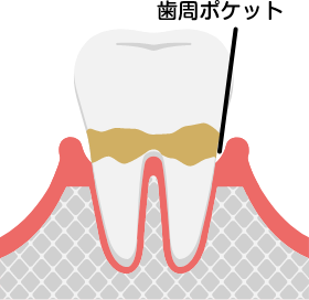 歯周病(軽度)