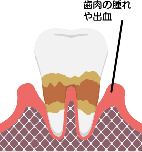 歯周病(中度)