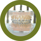 表側矯正（全体）