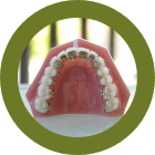 裏側矯正（上）