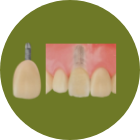 インプラント（CT診断含む）