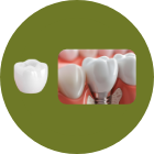 上部構造（※被せ物は特殊構造）